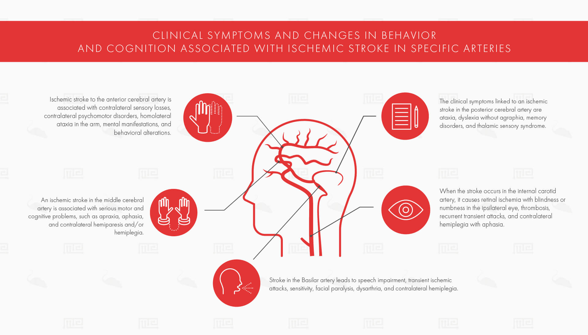 Ischemic Stroke Infographics